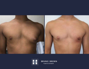 gynecomastia surgery before and after