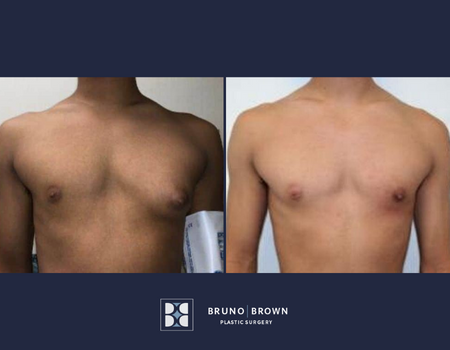 gynecomastia surgery before and after