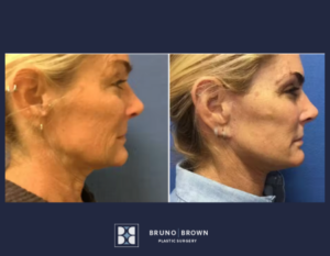 Before and after Facelift
