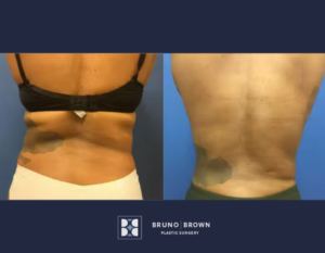 Before and after liposuction Washington DC