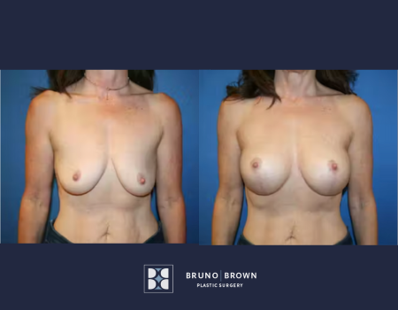 before and after breast augmentation of a middle age women