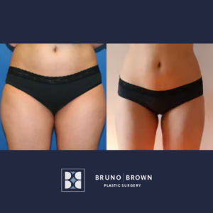 Before and after Lipo 360 in Washington DC