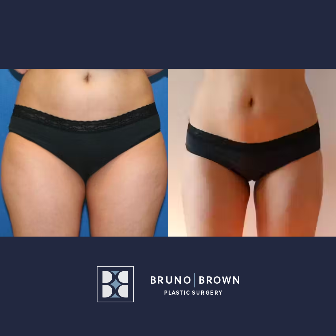Top 5 Cosmetic Surgical Procedures in 2024: What’s Trending