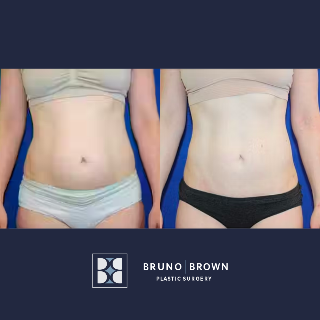 Before and after Lipo 360 in Washington DC