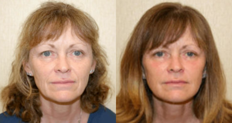 Facelift before and after