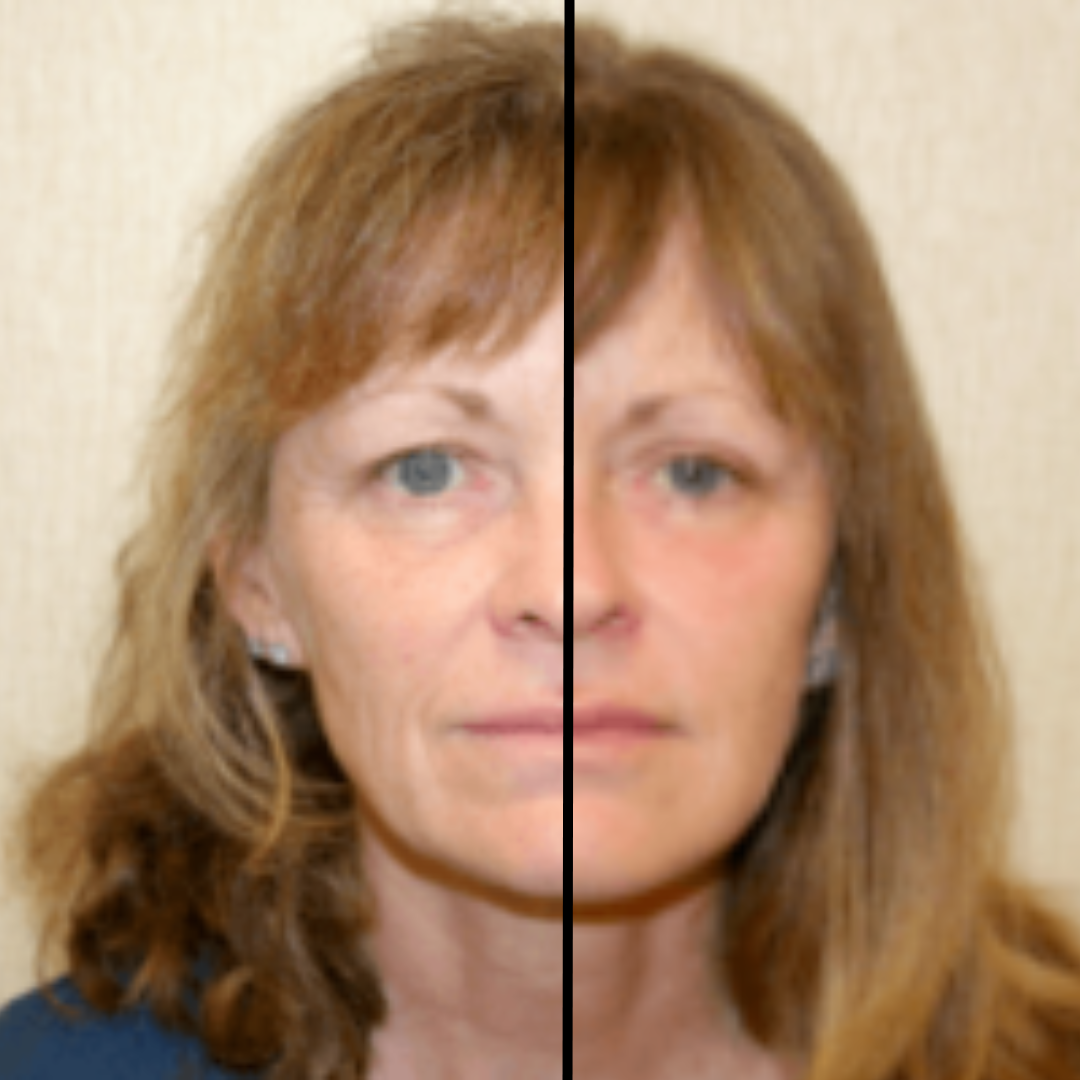 Before After Facelift