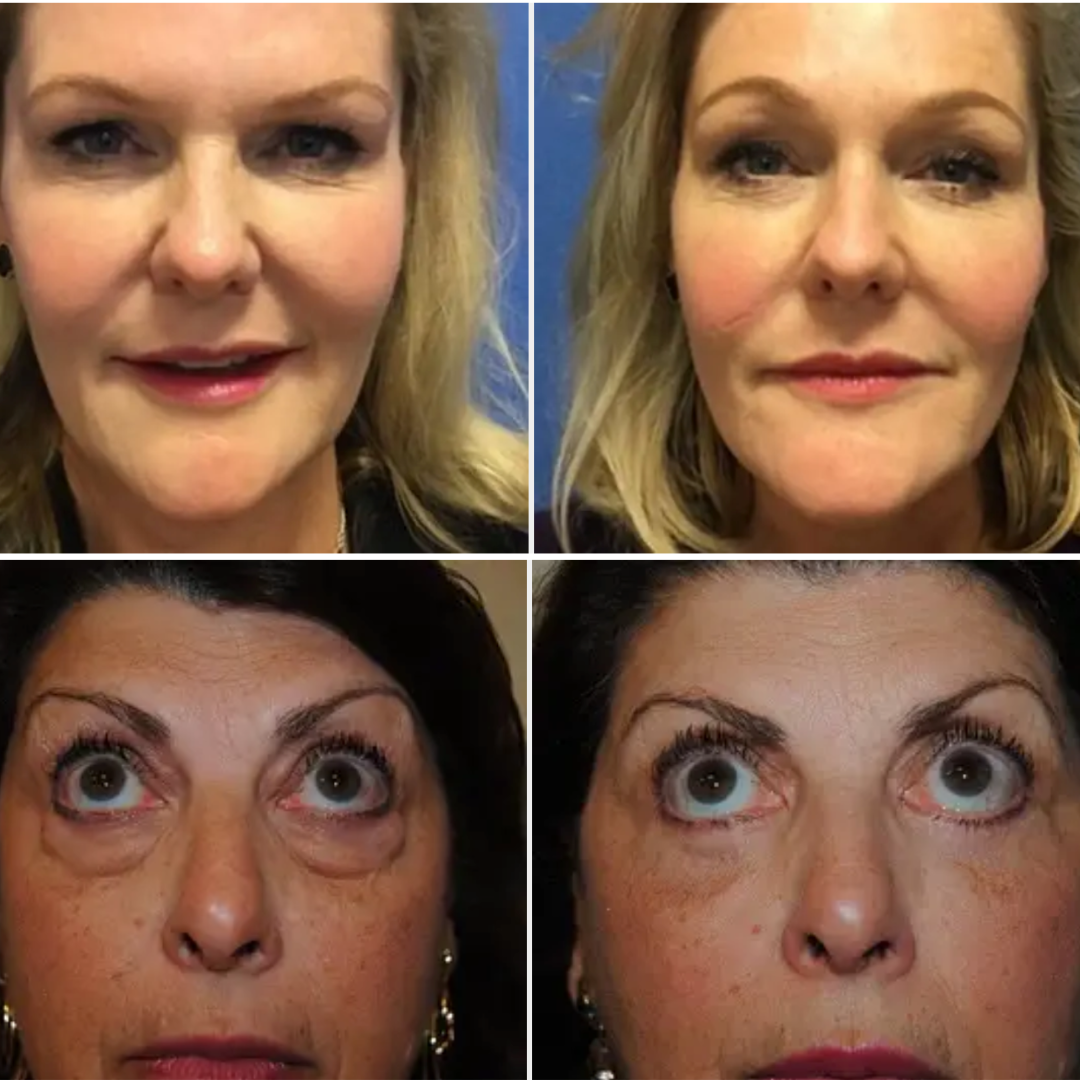 Should I Get A Brow Lift or Blepharoplasty? Here's The Difference