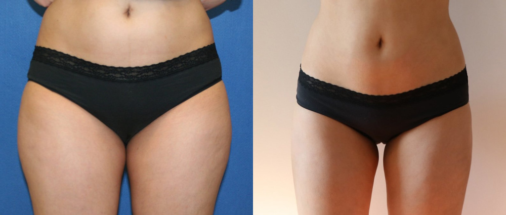 Liposuction Before and After