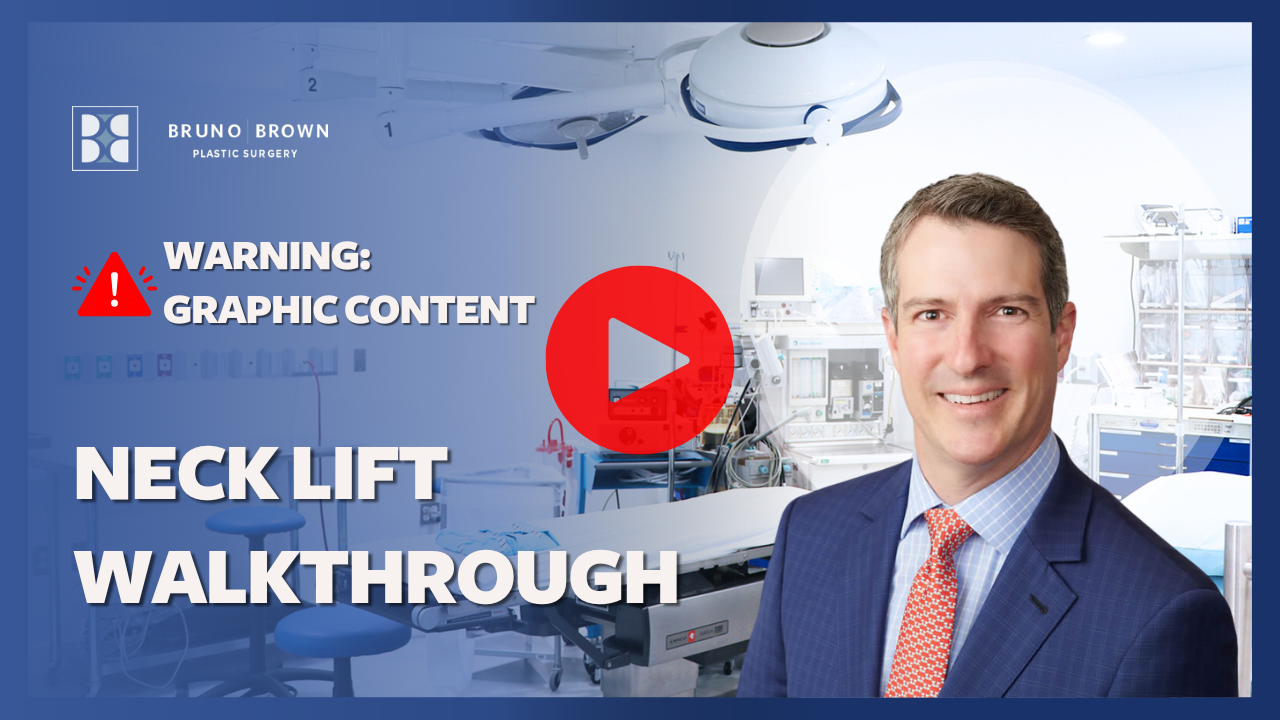 Neck Lift Washington DC Northern Virginia