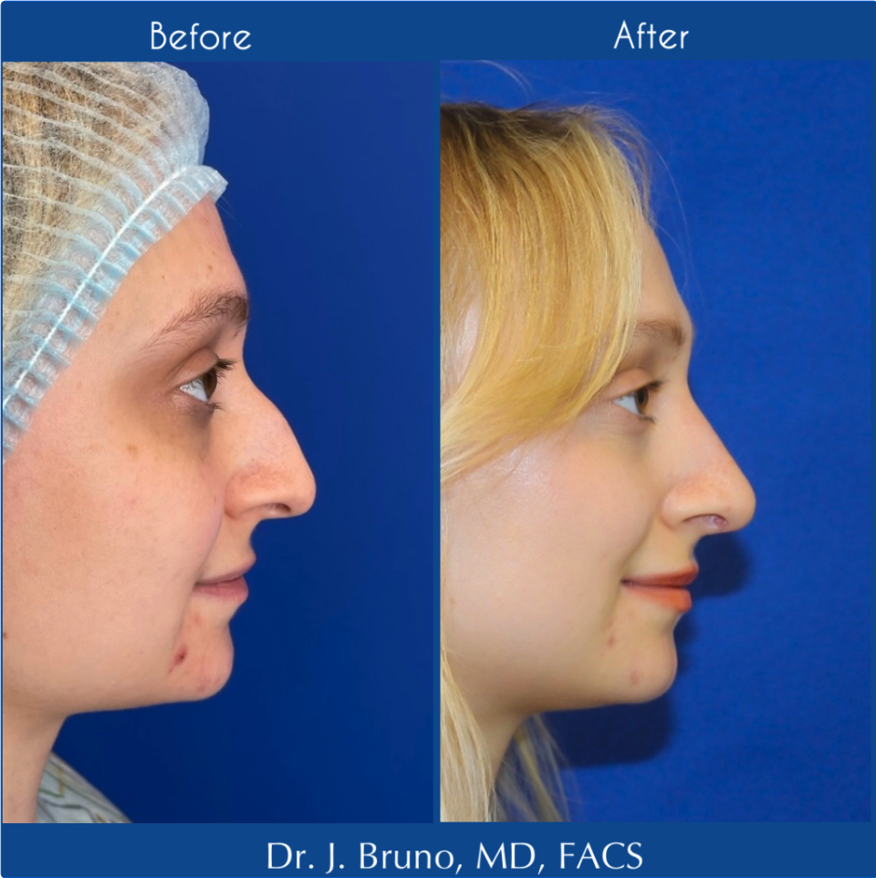 Rhinoplasty before and after Bruno|Brown
