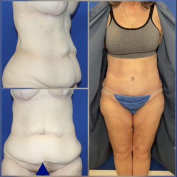Tummy tuck abdominoplasty transformation Chevy Chase Maryland Bruno|Brown Plastic Surgery