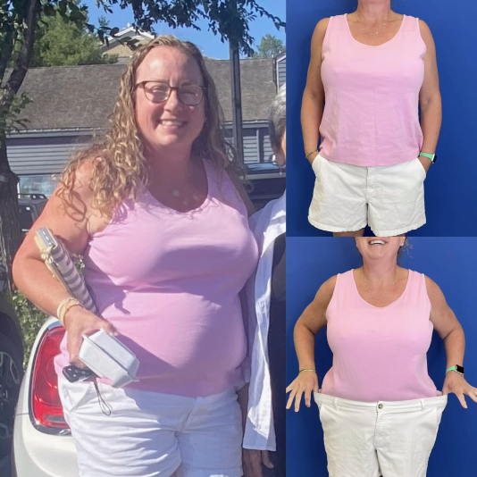 Semaglutide Transformation Becky Washington DC Bruno|Brown Plastic Surgery