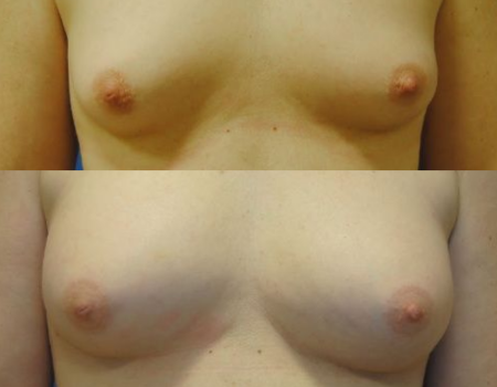 Breast Augmentation with Fat Grafting